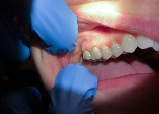 Best Emergency Tooth Extraction in Massanetta Springs, VA